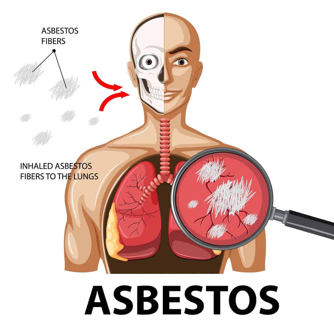 Diagram showing asbestosis in lungs illustration